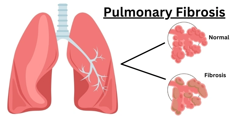 7 Things About Pulmonary Fibrosis Every Patient Should Know