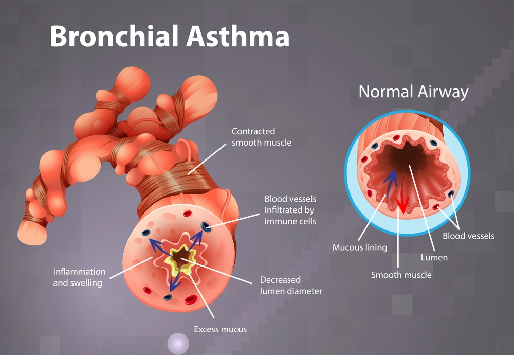 Understanding Bronchial Asthma: Symptoms, Diagnosis