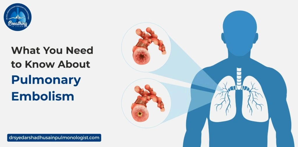 What You Need to Know About Pulmonary Embolism
