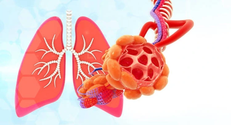 Pulmonary Fibrosis Treatment In Dubai